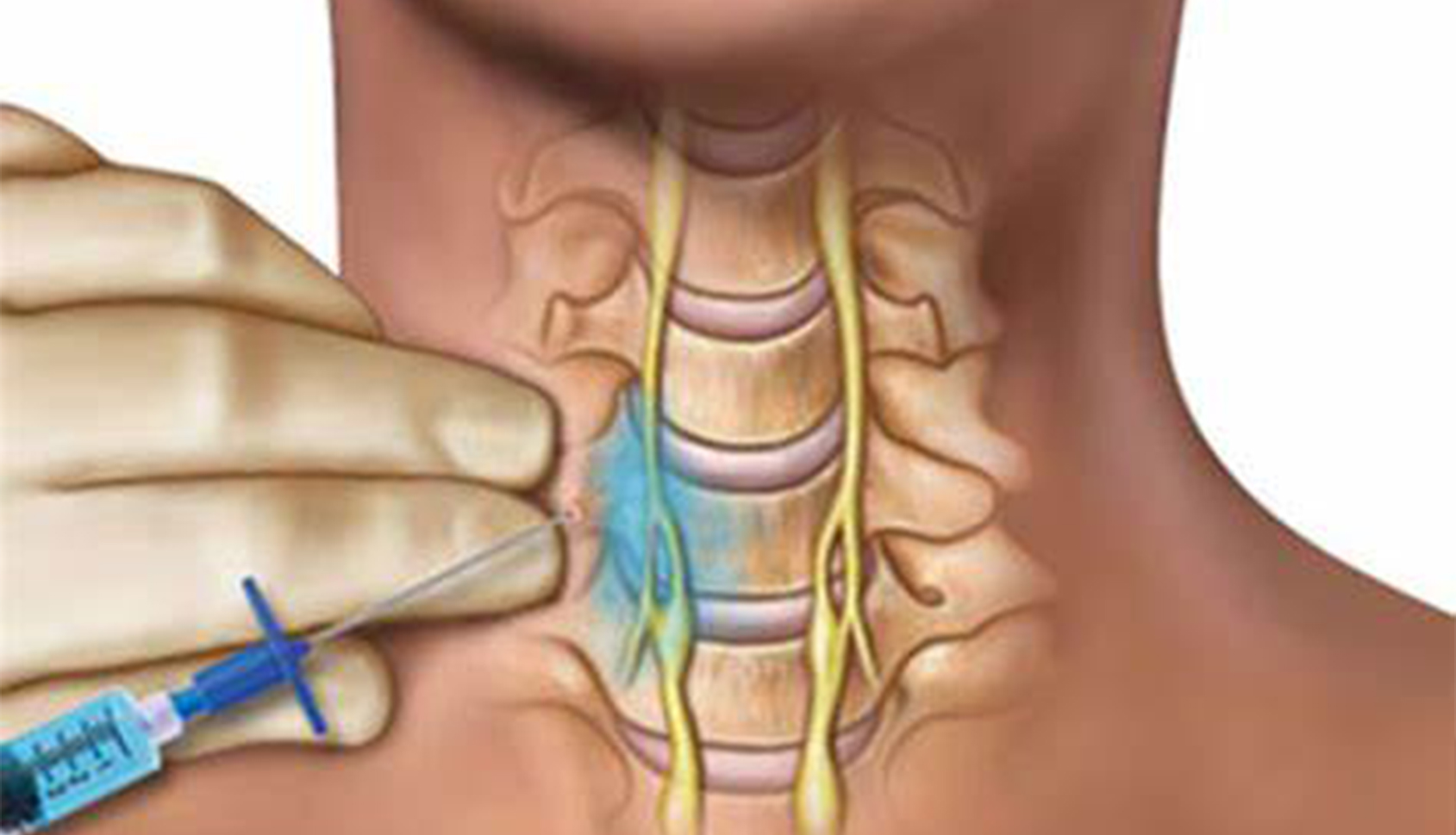 Stellate Ganglion block