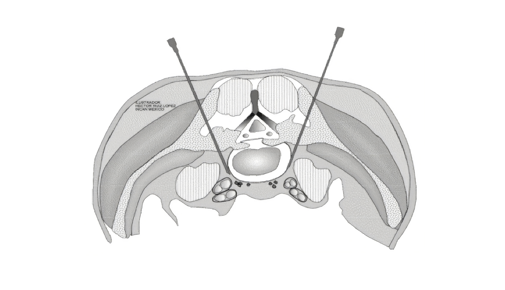 Superior hypogastric plexus block